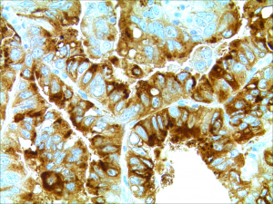 adenoca of lung ks11 3032